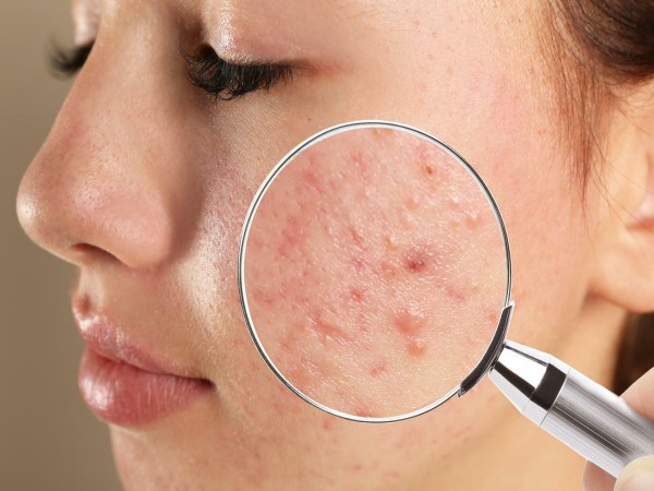 Các Bước Skincare Cho Da Dầu Mụn